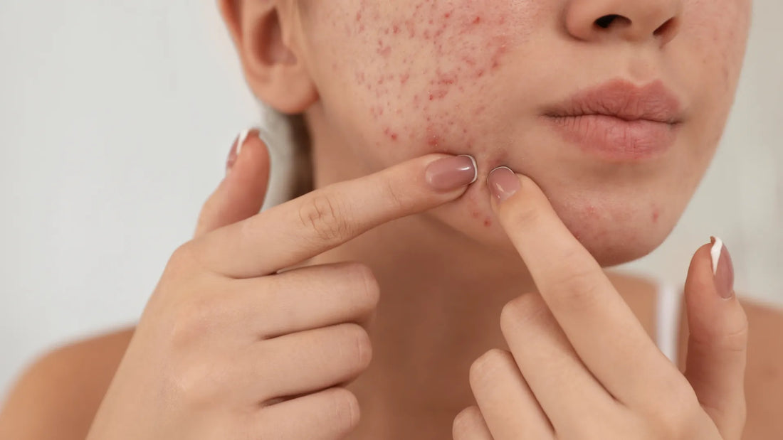 Simple Solutions for Acne-Prone Skin